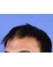 Before Hair Transplant&nbsp;2 Sessions (Areas)